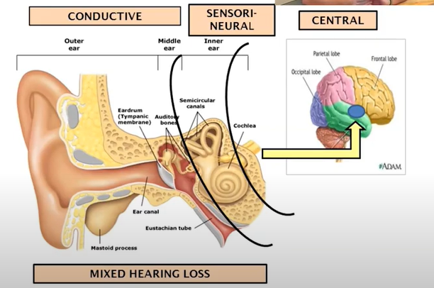 EarTalk July 2021 - Understanding Hearing Loss